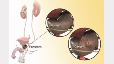 पिसाबको समस्या कतै प्रोस्टेट क्यान्सरको लक्षण त होइन?