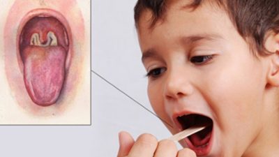 के हो डिप्थीरिया रोग ? कसरी बच्ने ?