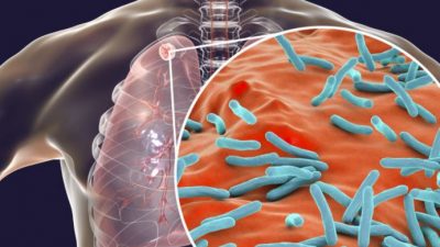 दक्षिणपूर्वी एसिया क्षेत्रमा क्षयरोग उन्मूलनको प्रयासलाई पुनः गति दिइने