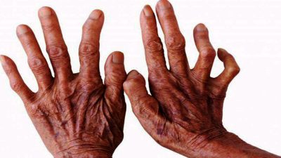 मन्कीपक्स संक्रमणको शंकास्पद मानिएको युवकमा कुष्ठरोग पुष्टि