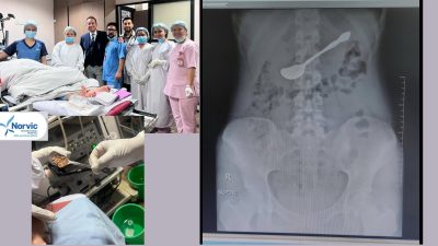 पेटमा अड्किएको चम्चा नर्भिकका चिकित्सकले बिना शल्यक्रिया निकाले