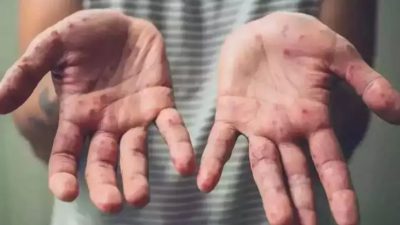 भारतमा मंकीपक्सको पहिलो केस पुष्टि