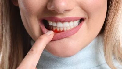 गिजा सुन्निने र रगत बग्ने समस्याबाट छुटकारा पाउने घरेलु उपाय